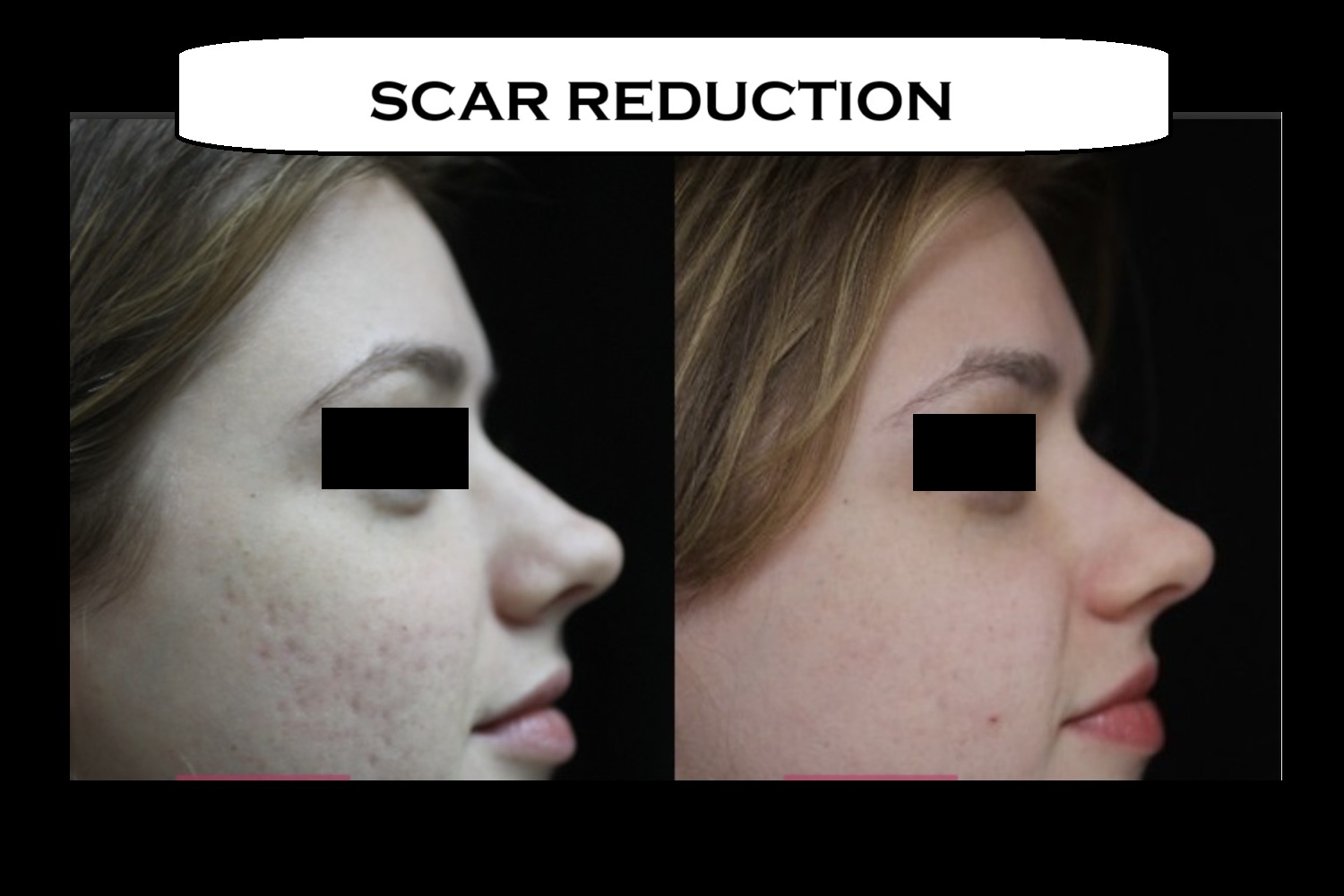 scar reduction